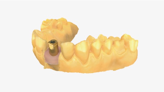 Aidite Rapid 3 – intraorálny skener pre komplexné implantátové a protetické prípady